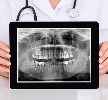 Panoramic dental x-rays