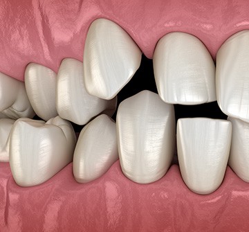 Illustration of spaced-out teeth