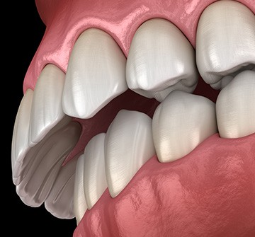 Illustration of overbite